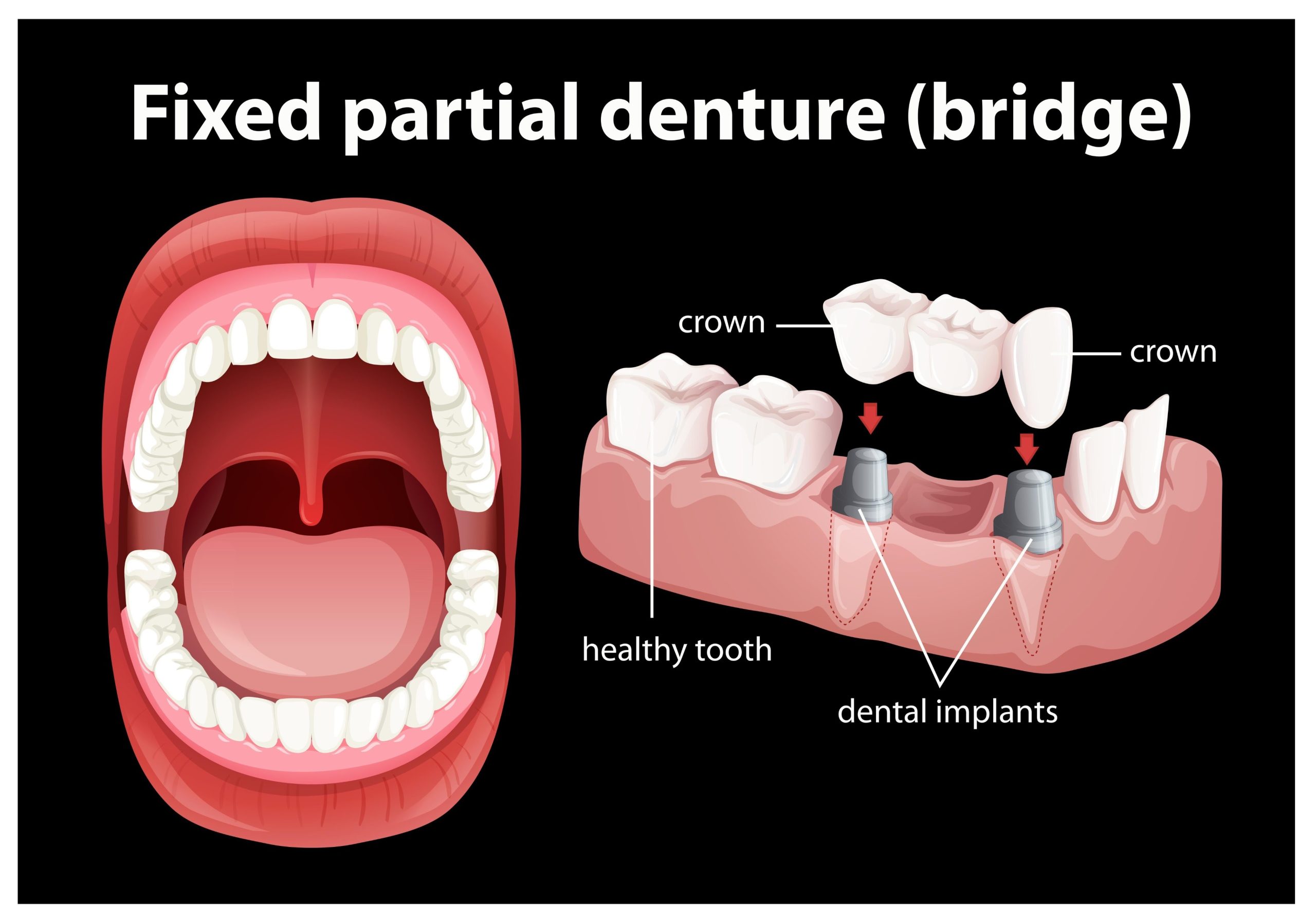 Image of full and partial dentures